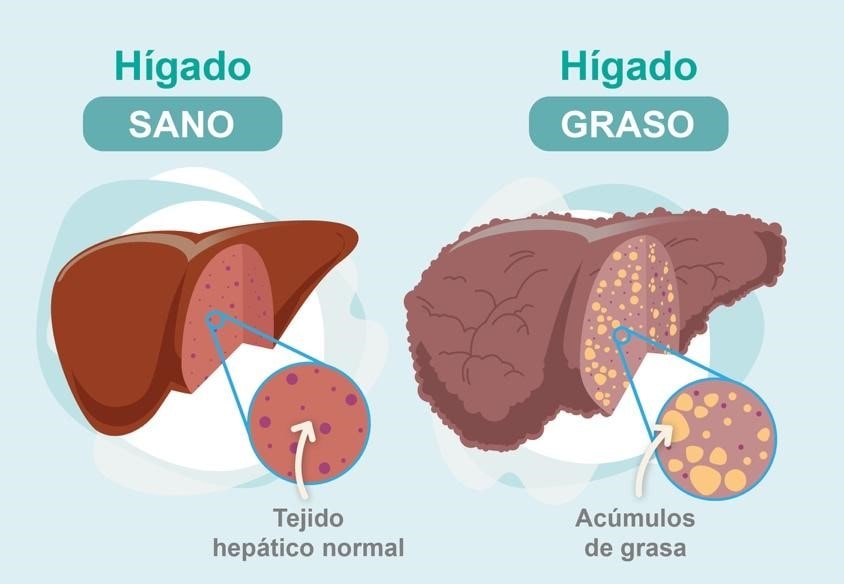 hígado graso