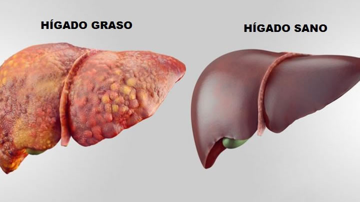 hígado graso